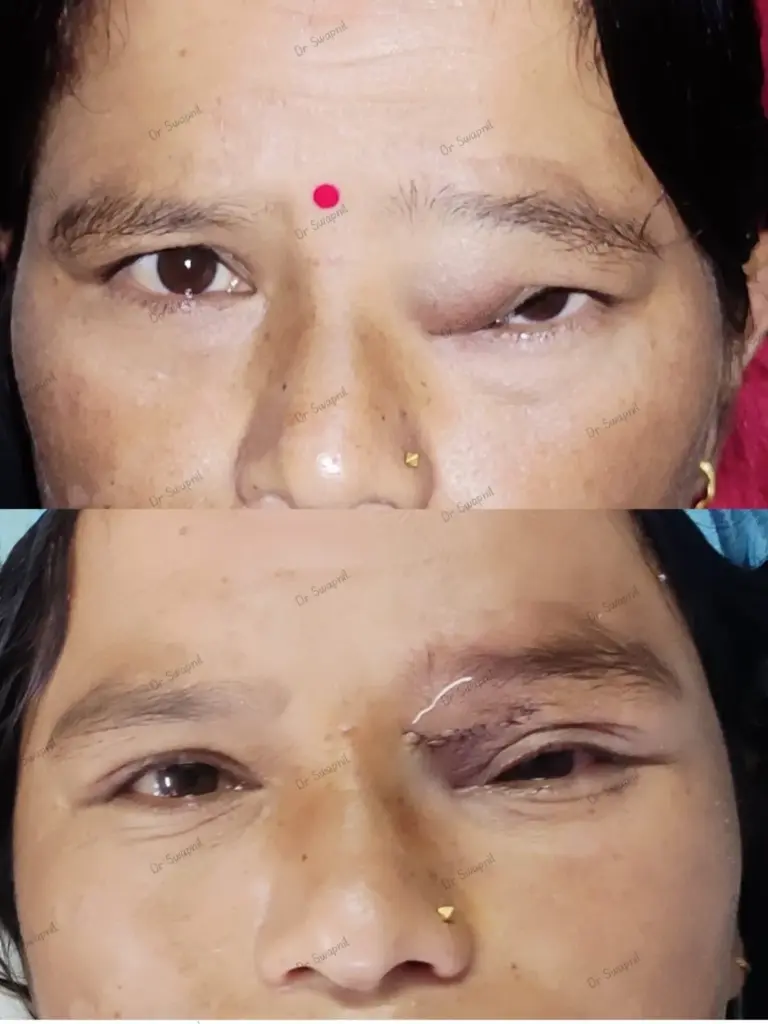 occuloplasty done at bhakti netralaya