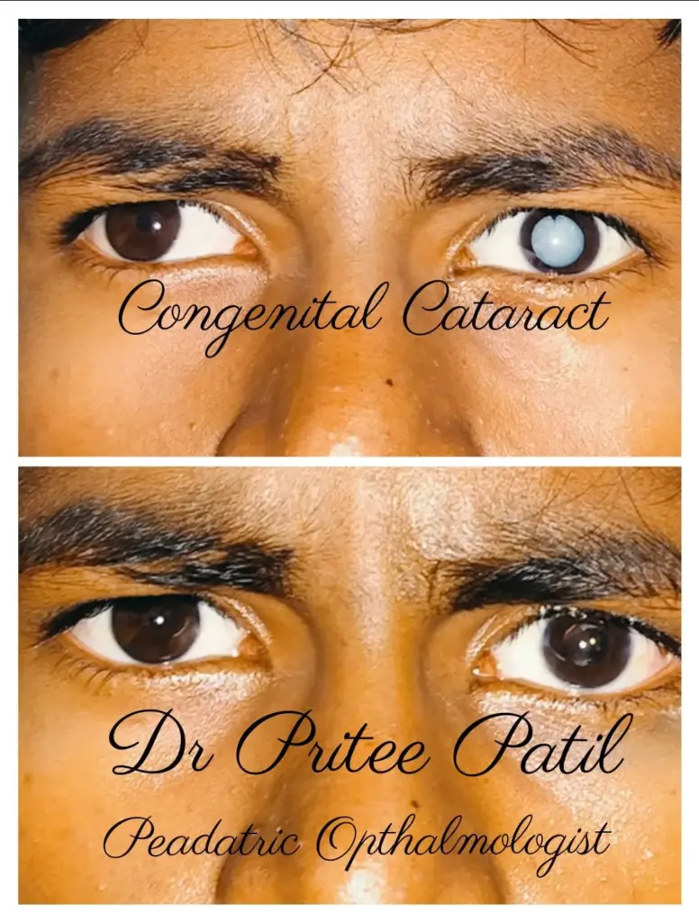 congenital cataract surgery at bhakti netralaya