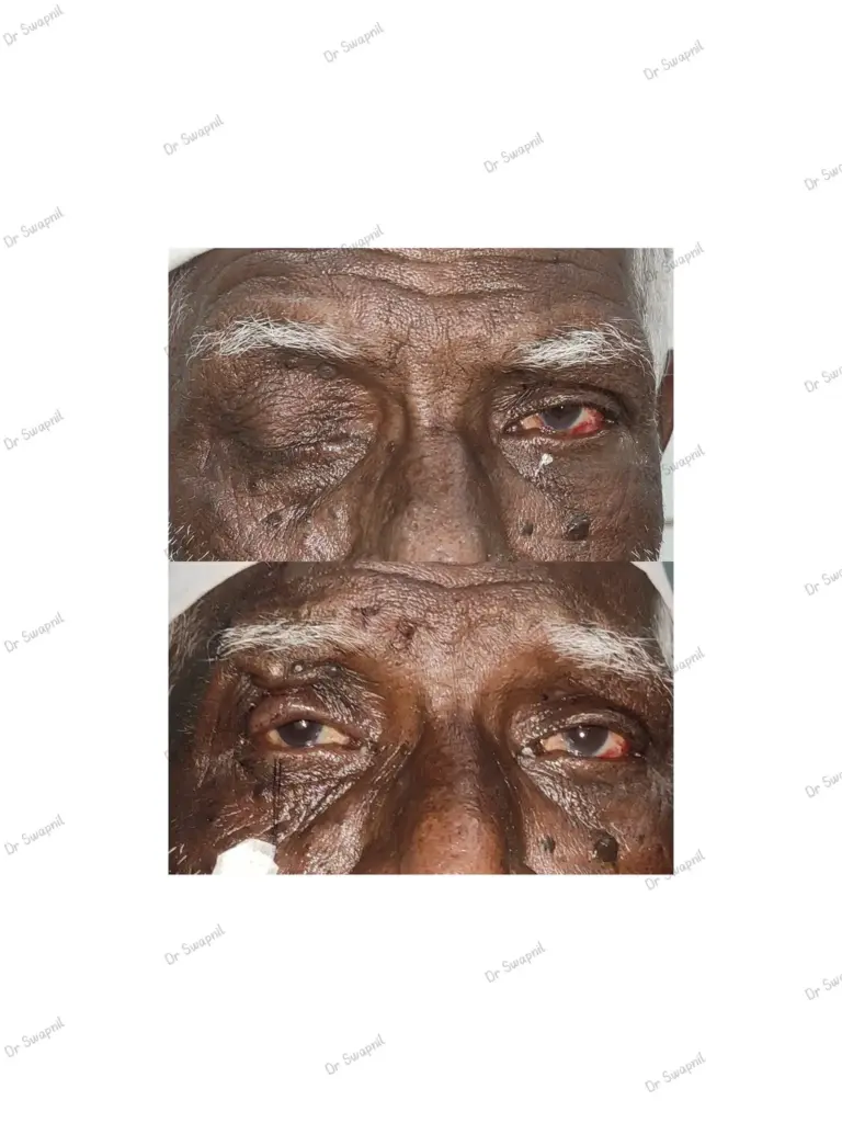 cosmetic surgery for eye